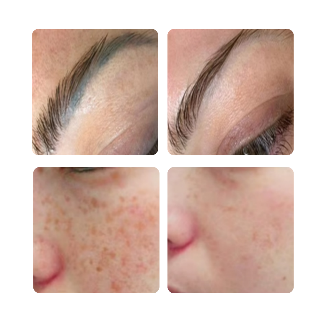 PicoClear Pikosekundový ND:YAG Laser na Odstraňovanie Tetovaní a Pigmentácií, 3 Vlnové Dĺžky - Image 7