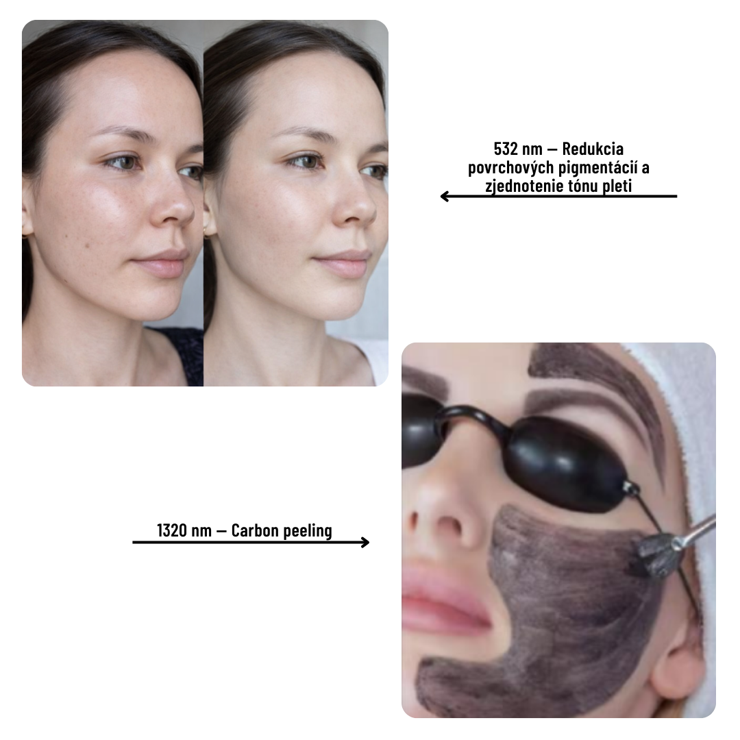 PicoClear Pikosekundový ND:YAG Laser na Odstraňovanie Tetovaní a Pigmentácií, 3 Vlnové Dĺžky - Image 8